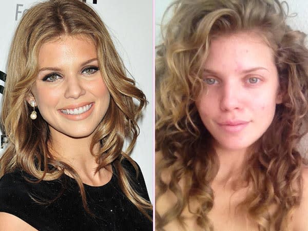 AnnaLynne McCord Reveals She Has Skin Problems Too — So Inspiring