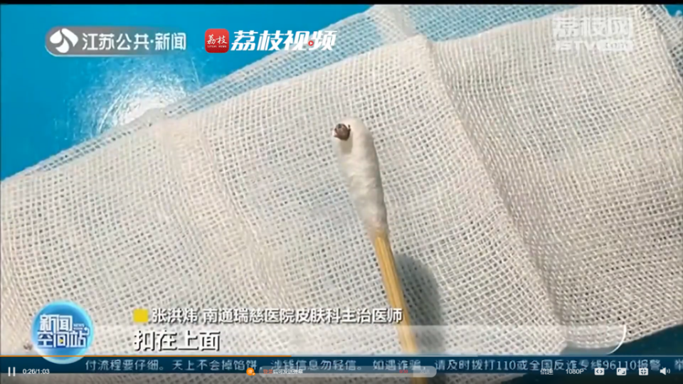 大陸一名女童，後頸部竟出現怪異小黑痣，結果就醫檢查竟是遭一隻「吸血蟲」侵入。（圖／荔枝新聞）