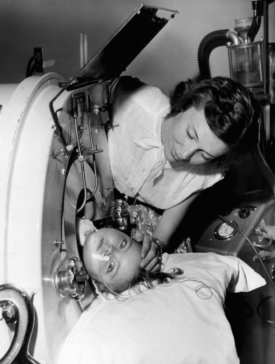 2-year-old girl in an iron lung from polio