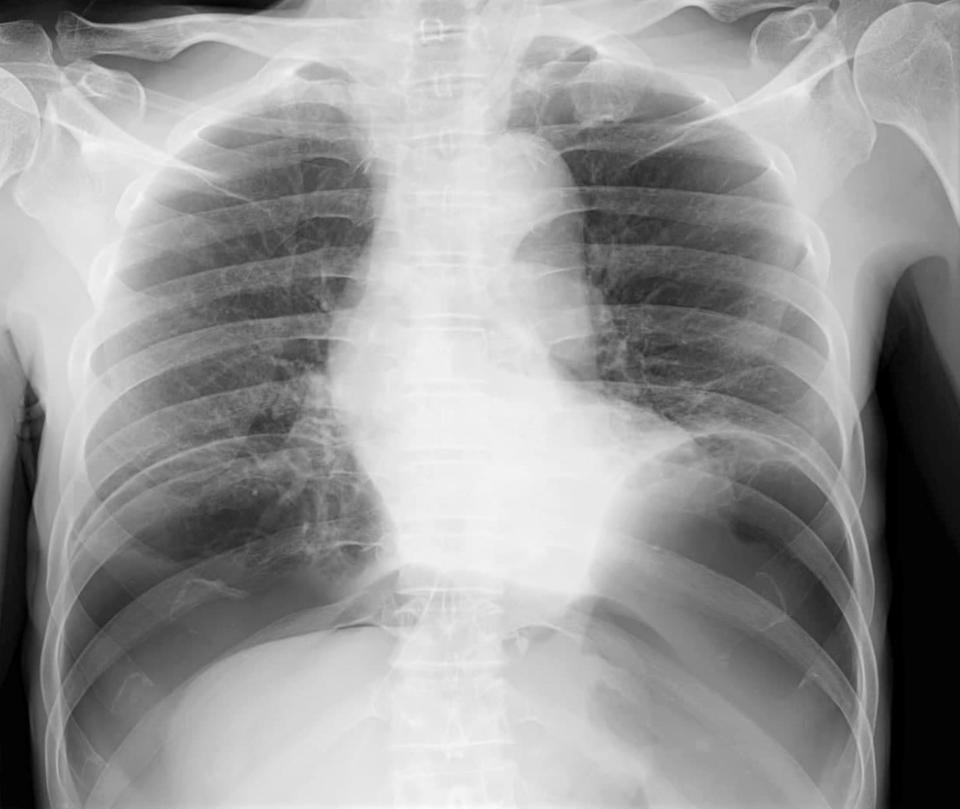 X-ray image of a human chest showing the ribs, lungs, and spine, with a focus on the heart and surrounding areas