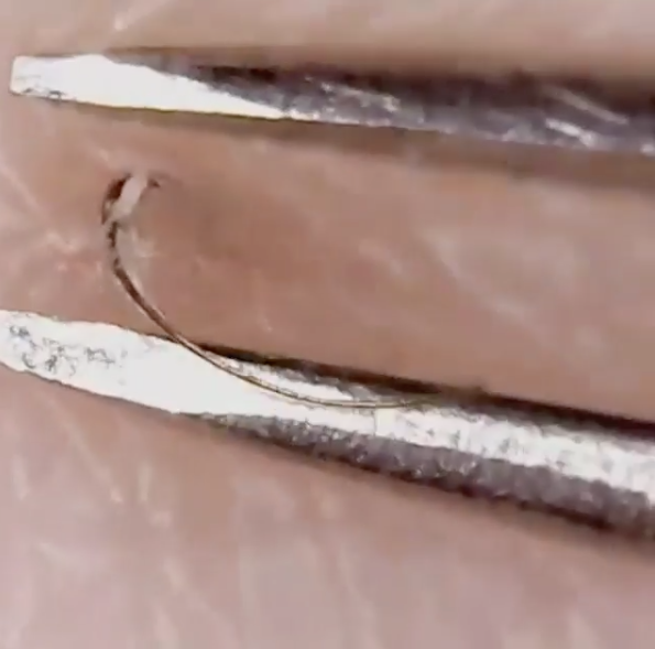 If you love the satisfaction of removing an ingrown hair, this is the Instagram account for you. Photo: Instagram