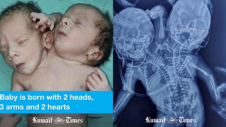 印度1對夫妻產下詭異的「連體嬰」，不但有2顆頭以及3隻手。（圖／翻攝自推特）