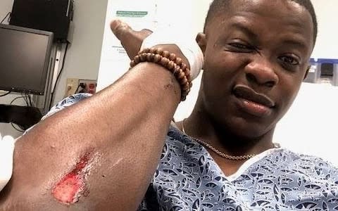 James Shaw displays the wound he suffered while tackling a gunman at a restaurant in Nashville, Tennessee - Credit: James Shaw