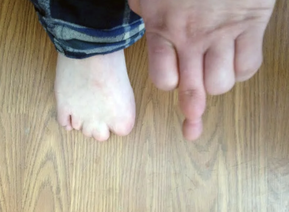 the person has no toes and one of their fingers looks like it had a string around it