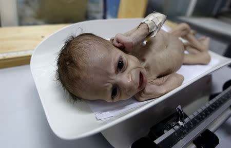 Ali Mohammed al-Tawaari, a six-month-old malnourished boy, cries as he is weighed in a malnutrition intensive care unit in Sanaa, Yemen July 30, 2015. REUTERS/Khaled Abdullah