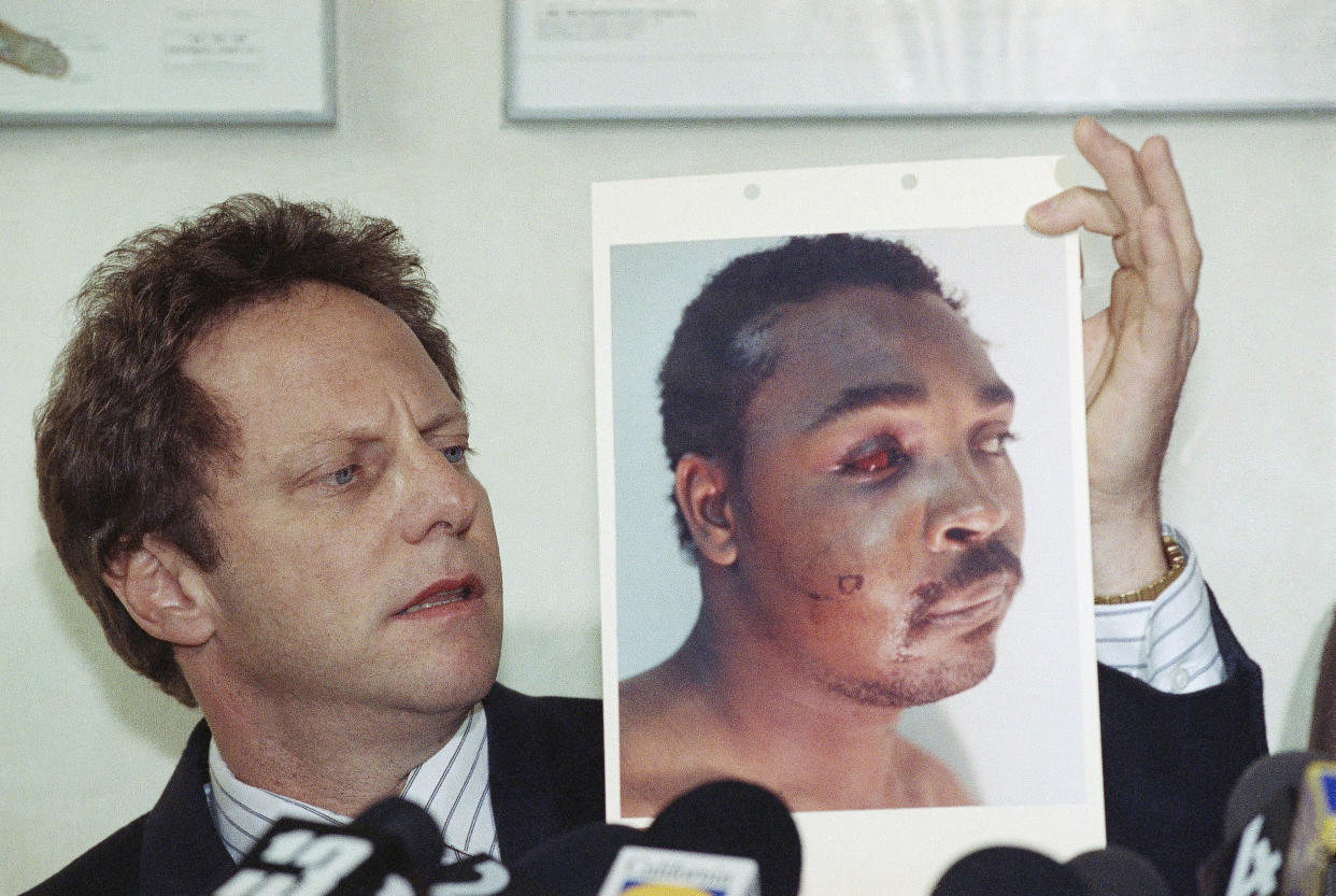 Steven Lerman, attorney for Rodney King, displays a photo of his client during a press conference at his office in Beverly Hills, California, Friday, March 8, 1991. King's doctor outlined the extent of man's injuries for reporters during the meeting. (Nick Ut/AP Photo)