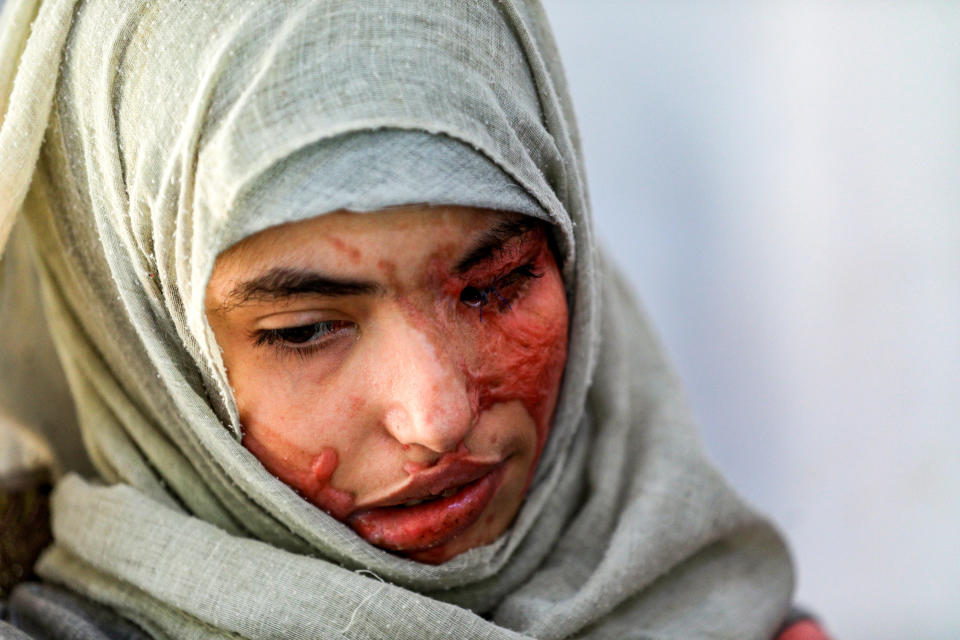 EDITORS NOTE: Graphic content / Al-Anoud Hussain Sheryan, a 19-year-old girl disfigured in an acid attack by her abusive husband, sits at a hospital where she is undergoing treatment in Yemen's capital Sanaa on January 28, 2021. - Married at the age of 12, rejected at 16, and then disfigured in an acid attack, Sheryan's fate is a shocking illustration of abuse in a society beset by war and poverty. Now aged 19, the young Yemeni woman agreed to relate her ordeal at the hands of her abusive husband -- rare testimony in a country where domestic violence is largely hidden. (Photo by Mohammed HUWAIS / AFP) (Photo by MOHAMMED HUWAIS/AFP via Getty Images)