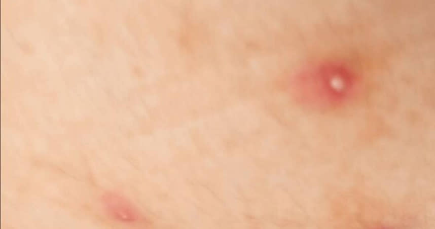 台南市政府衛生局25日公布猴痘患者大腿病灶照片，與海外感染者情況不甚相似。（圖／台南市政府衛生局提供／中國時報程炳璋台南傳真）