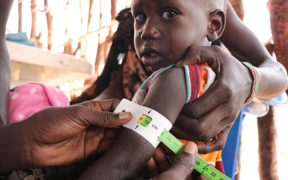 A malnourished child being assessed at a nutrition clinic in Fangak county. There are 1.3 million children under five years of age who suffer from malnutrition in South Sudan - WFP/Marwa Awad 