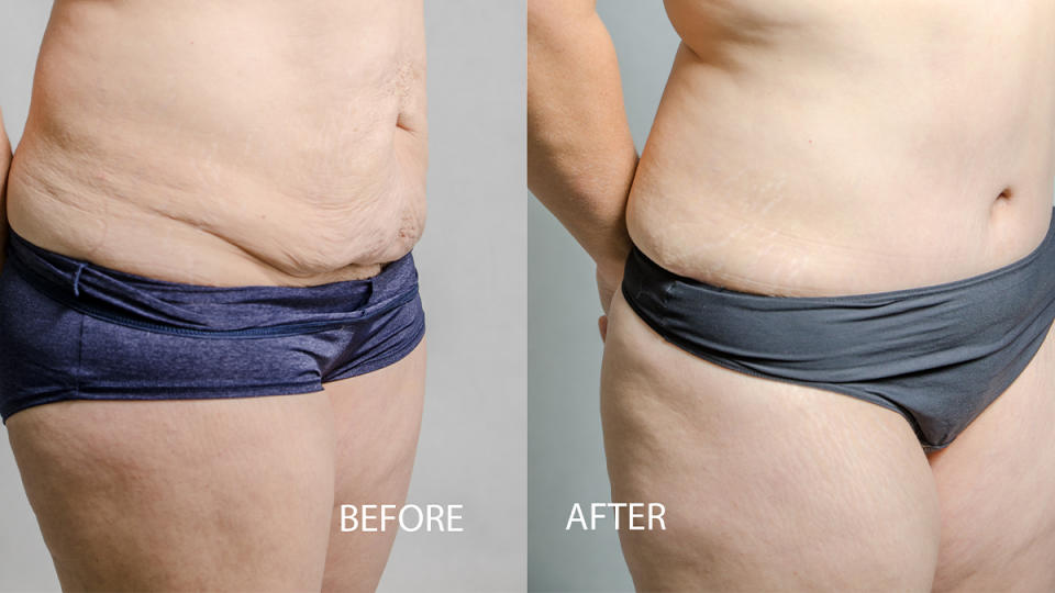 tummy tuck before and after