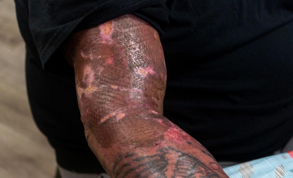 Kahlil "Bubba" Floyd shows how his arm looks now during an interview at one of The Tattooed Pig locations, which he runs with his wife, Angie Floyd, in Aston on Monday, Oct. 9, 2023. Floyd had been burned on Sept. 2, 2023, when a car struck the food truck he was working in in Wimington's Trolly Square area.