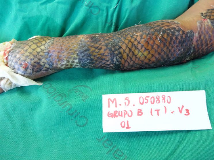 Maria Ines burn wounds were treated with the skin from Tilapia fish. (Photo: Caters News)