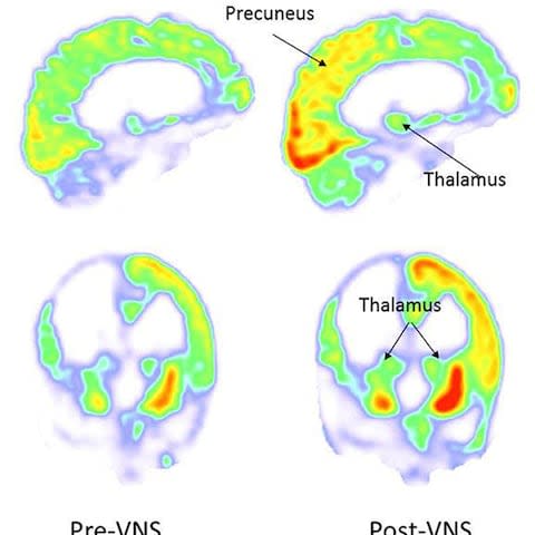 Images show how brain stimulation in the patient changed - Credit:  Corazzol et al/PA