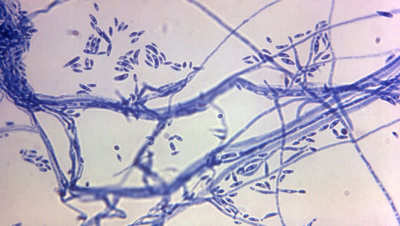 This microscope photo provided by the Centers for Disease Control and Prevention shows a Fusarium sp. fungal organism in 1972. The CDC says the death toll has risen to six in an outbreak of fungal meningitis tied to surgical procedures in a city along the U.S.-Mexico border, and they have not been able to reach everyone who may be at risk of infection. Labs have detected fungal signals consistent with Fusarium solani species complex from the cerebrospinal fluid of patients receiving follow-up care in Mexico or the United States.