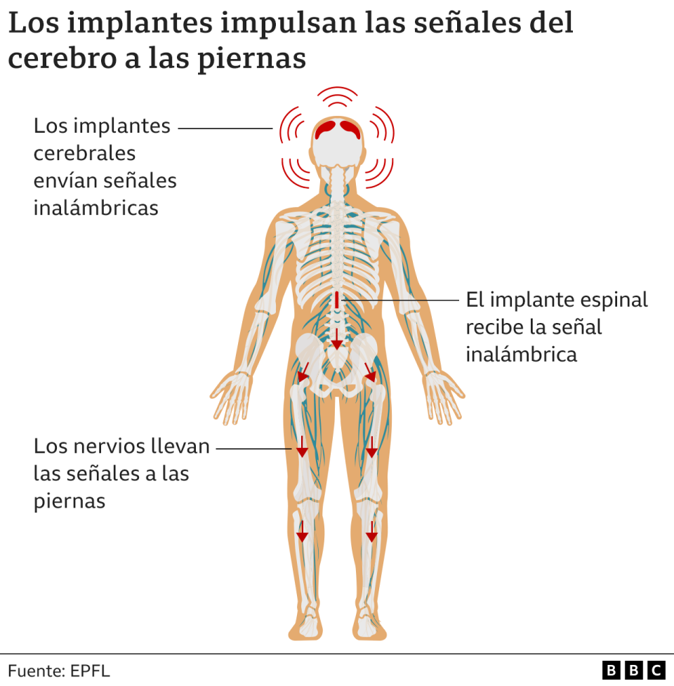 Gráfico muestra la función de implantes cerebrales y medulares