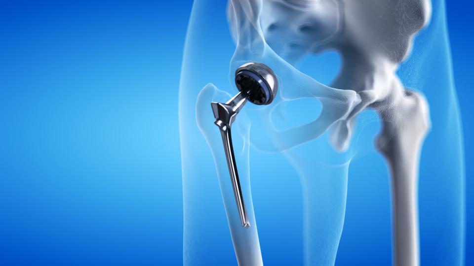 What to expect from a hip replacement. (Image via Getty Images)