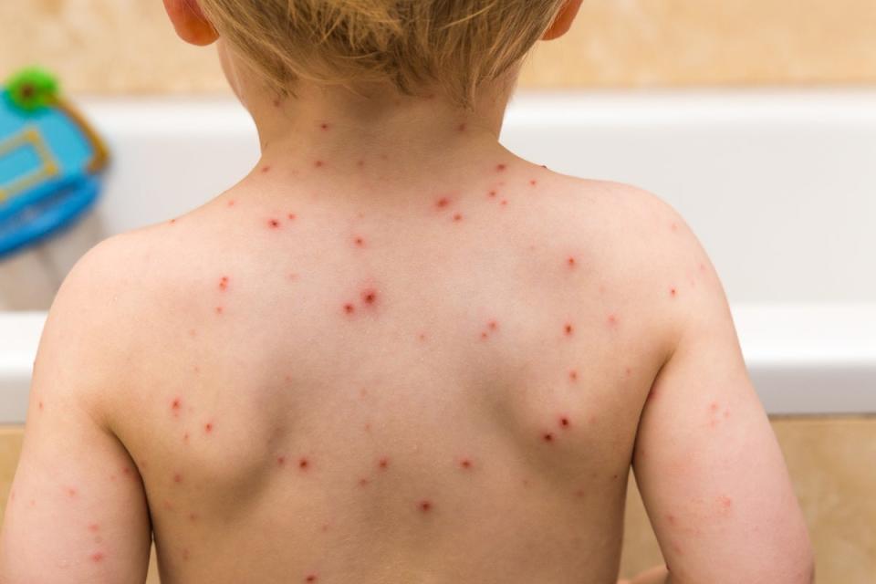 Scientists advising the government have recommended the chickenpox vaccine to be added on the NHS for children (Getty Images)