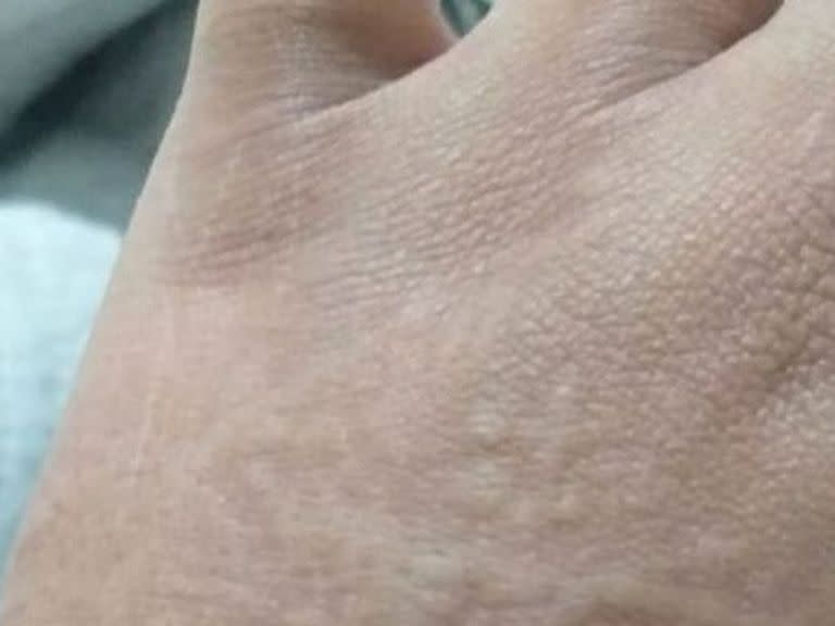 La urticaria es una de las patologías cutáneas asociadas al Covid-19