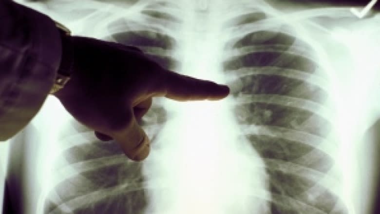 Tuberculosis likely in Grand Falls-Windsor case