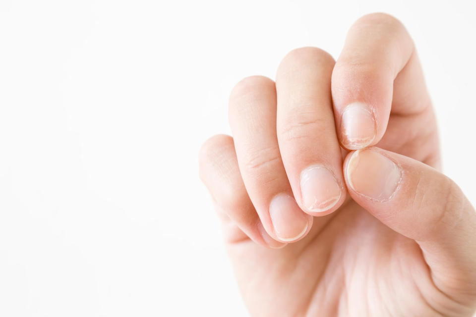 La onicosquicia, condición que describe las uñas quebradizas, puede estar asociada a la exposición a la humedad constante y a sustancias químicas, así como al envejecimiento, entre otros factores. (Getty Creative)