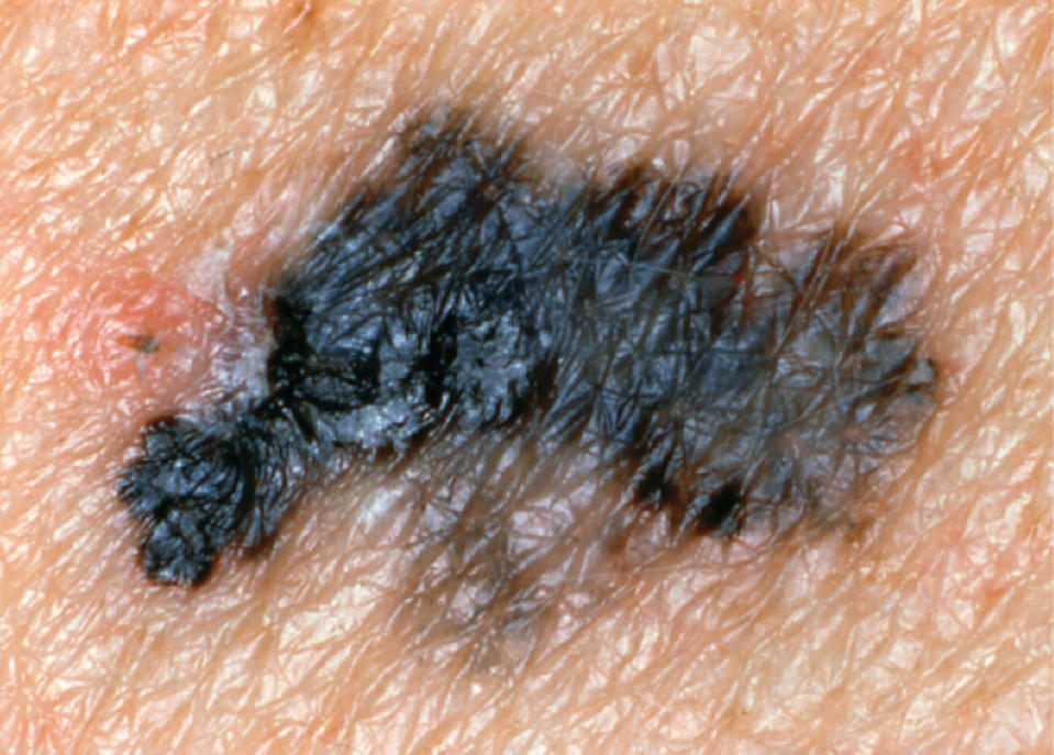 picture melanoma with irregular border (Courtesy The Skin Cancer Foundation)