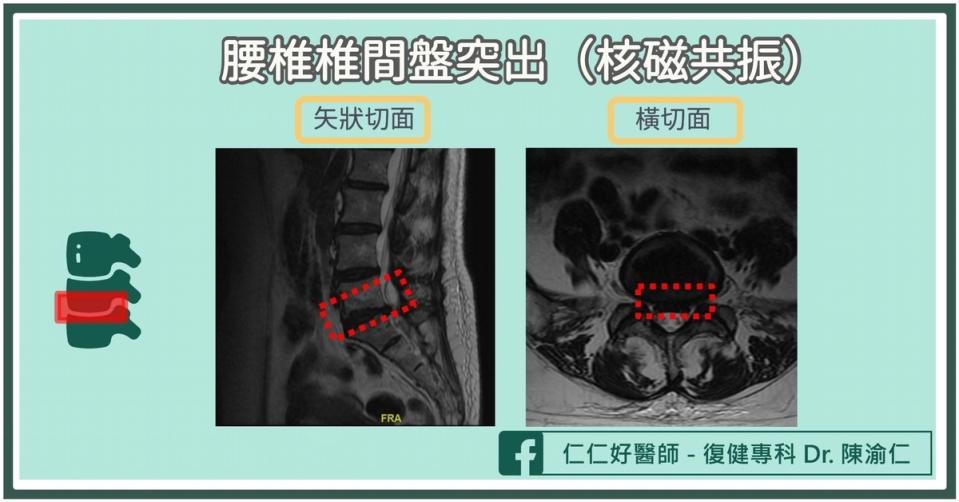 單車運動傷害2：脊椎