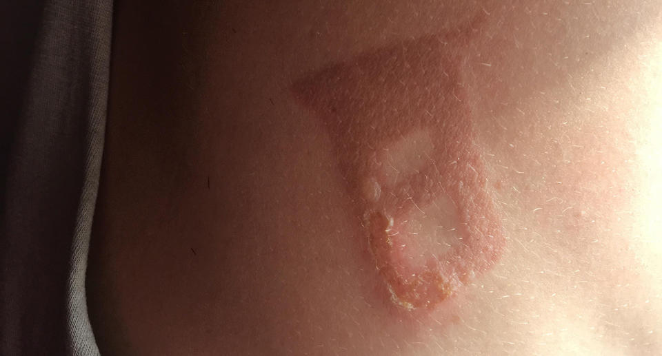 It was so hot in parts of Victoria last week that one man was left with a horrific burn after coming into contact with a scorching seatbelt buckle. Image: Reddit