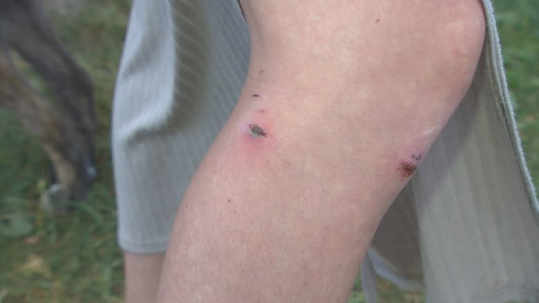 Woman bitten by pit bull while protecting her dog issues warning