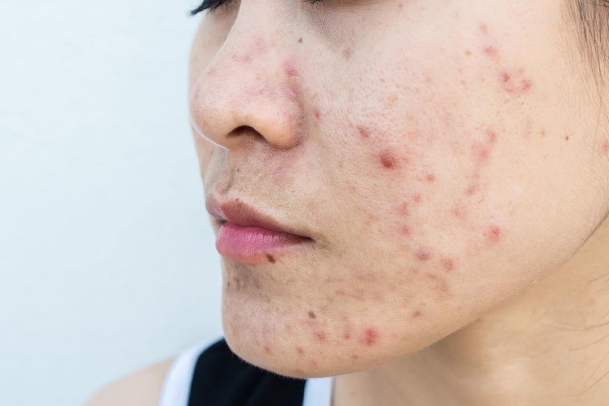 close up of woman face has variety problems on her skin such as acne, pimple, pores and melasma etc