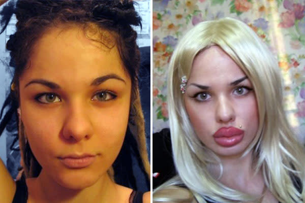 Woman Gets 100 Silicone Injections To Have The Worlds Biggest Lips 