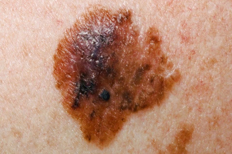 a mole on skin with uneven shape and edges