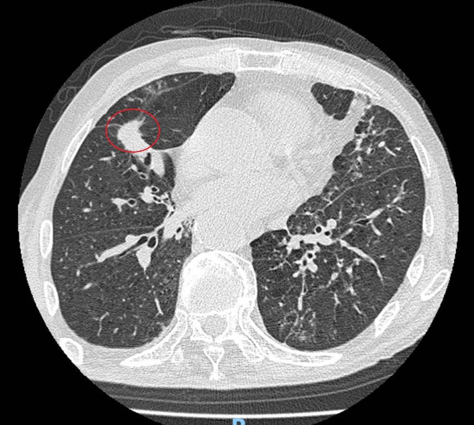 ▲彰化醫院從電腦斷層看到疑似肺癌陰影(紅圈處)。（彰化醫院提供）
