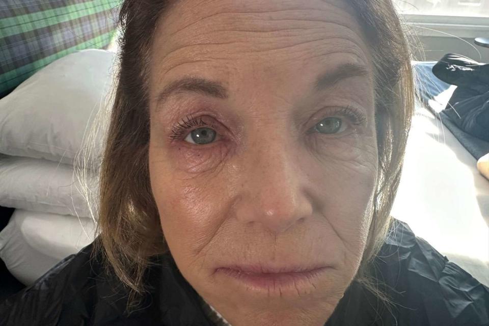 <p>Katie Couric/instagram	</p> Katie Couric shows off sensitive skin reaction