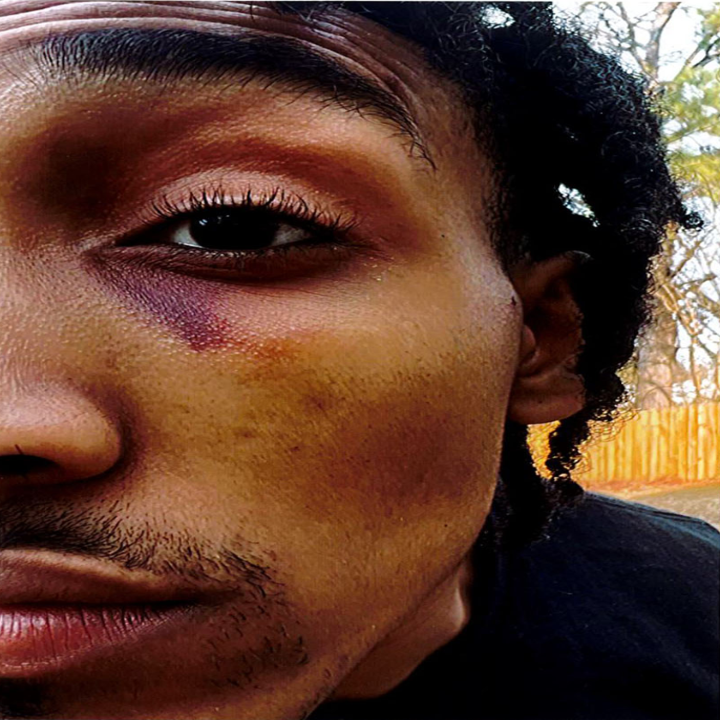 Photos show Monterrious Harris with injuries nine days after he was allegedly assaulted by the officers who beat Tyre Nichols.