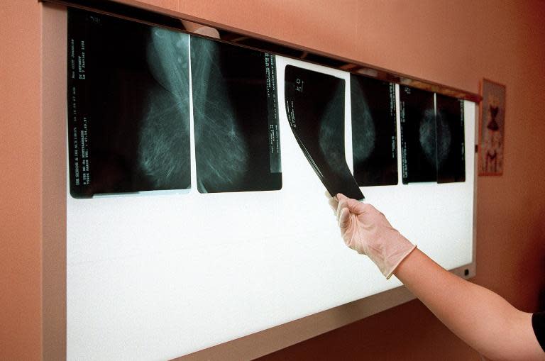 The study involved 235 women with breast cancer diagnoses ranging from stage 0 to 3, some of whom were randomly assigned to have extra tissue around the tumor removed -- known as cavity shave margins (CSM) -- and some who were not