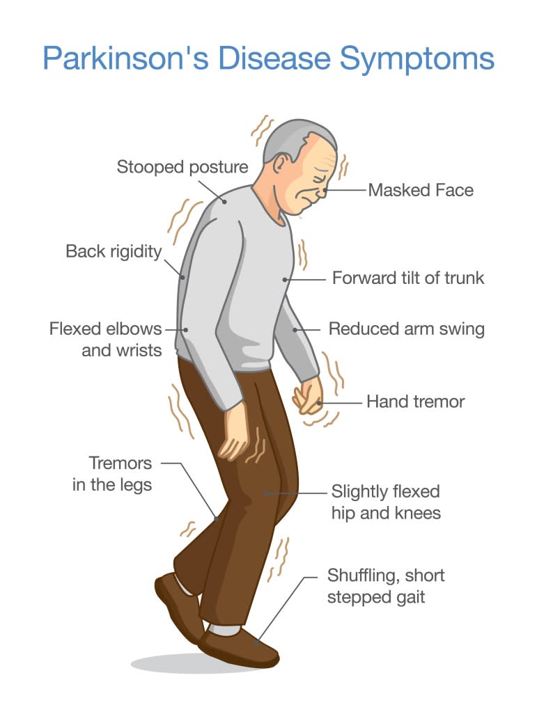 Parkinson’s sufferers improved their overall quality of life, mobility, motor skills, and walking speed — with an increase of 0.27 meters per second — after completing the eight-week program. logo3in1 – stock.adobe.com