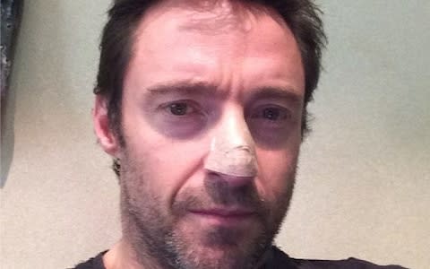 Actor Hugh Jackman recently revealed he had been treated for skin cancer - a basal cell carcinoma - after seeking advice for a mark on his nose. - Credit: @RealHughJackman / Instagram