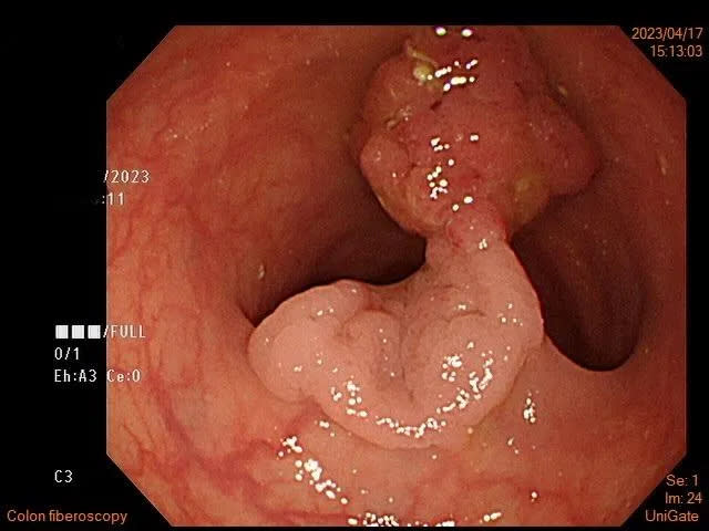 女病患的息肉近四公分，但寬度仍在切除線圈範圍內，內視鏡觀察癌症風險不高，當場將其切除即可。（圖／<a href="https://www.facebook.com/profile.php?id=100093161577871&__cft__[0]=AZXMOXavEvixI1M421RTJNPWiEz6_tp7HI0gw0QgJeRKGNb1ehd7XqMUuCI0gXnIuH7hfrpFpWiMaFeKqonVZT6NV5haCZx-CAt_lUkr_M2r_WEG7kNkC9FSQRwyD46MI4sPYyEx6DkQzrq-KdSjBRm5&__tn__=-UC%2CP-R" rel="nofollow noopener" target="_blank" data-ylk="slk:胃腸專家 葉秉威醫師;elm:context_link;itc:0;sec:content-canvas" class="link ">胃腸專家 葉秉威醫師</a>）