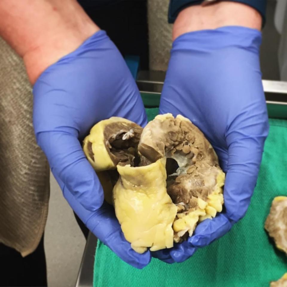 hands in medical gloves hold diseased heart