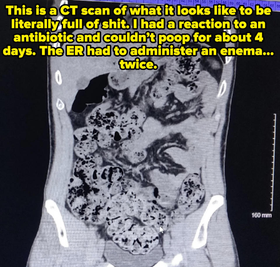 Medical scan of a human abdomen showing detailed internal organs, including darkened areas indicating possible complications