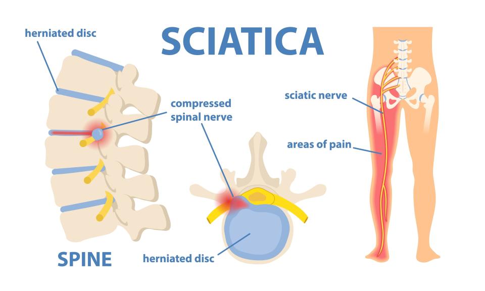 Sciatic nerve pain in the lower back through hip, thigh, knee to leg. Educational or informational poster. Flat vector medical illustration isolated on white background / Credit: Getty Images/iStockphoto