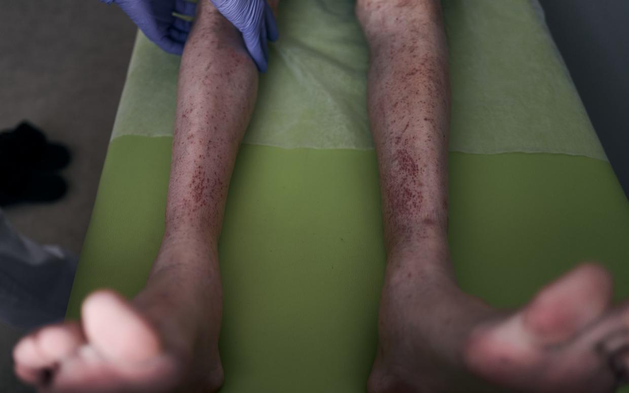Bruises and lesions mark the legs of a soldier