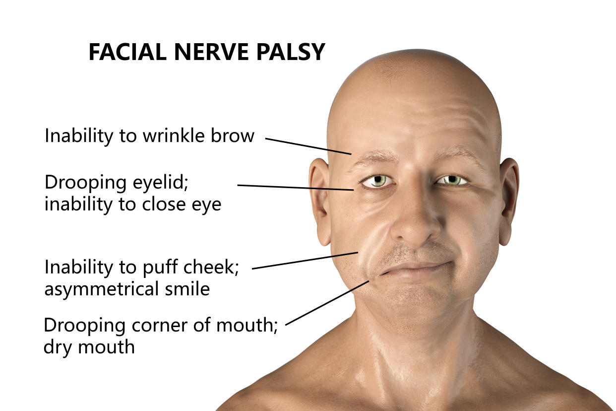 Labelled illustration of Bell's palsy, a unilateral facial paralysis. The condition is due to the inflammation of the facial nerve. It causes facial drooping, numbness, inability to close the eye and may also cause nervous tics. Onset may be overnight. The cause is not known although in some cases it may be due to infection with herpes virus. Treatment is with anti-inflammatory and antiviral drugs. The condition will resolve itself over time.