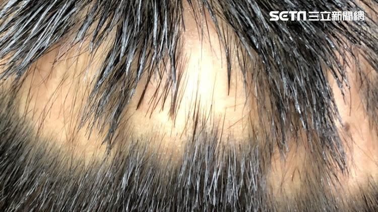 圓禿俗稱鬼剃頭，最常發生的部位是頭皮，但全身有毛髮覆蓋的地方都有可能出現。（圖／黃毓惠醫師提供）