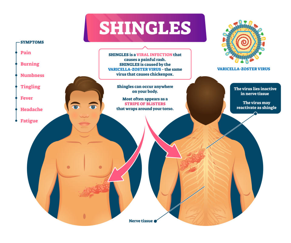 Shingles infographic (Image via Getty Images)