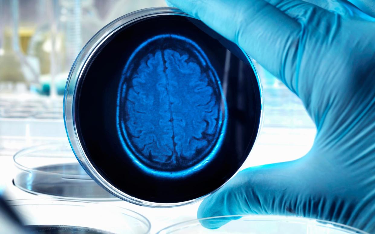 Scientist holding a petri dish with a brain scan illustrating research into dementia, alzheimers and other brain disorders