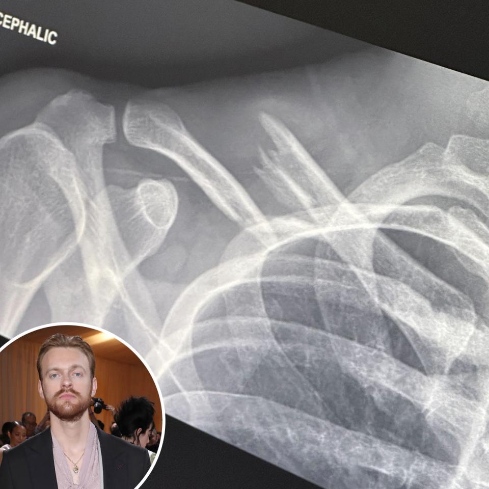 Finneas O'Connell, X-Ray