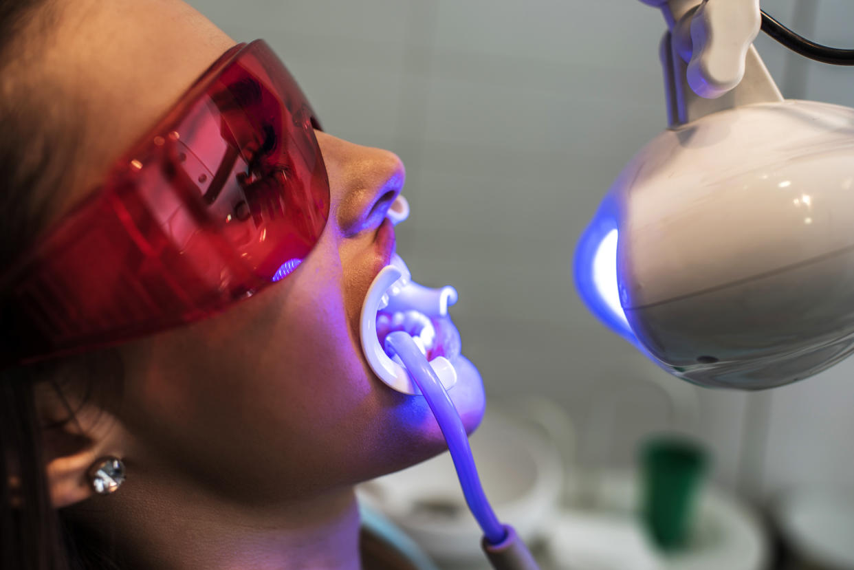 El proceso de blanqueamiento dental en un consultorio puede ser costoso, por ello, una pluma o bolígrafo blanqueador es una buena opción. (Foto: Getty)