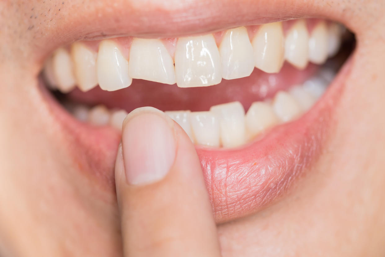 Laut einer Umfrage hatten bereits 66 Prozent der Deutschen einen Zahnunfall. Was in einem solchen Fall zu tun ist, wissen allerdings nicht viele. (Foto: Getty Images)