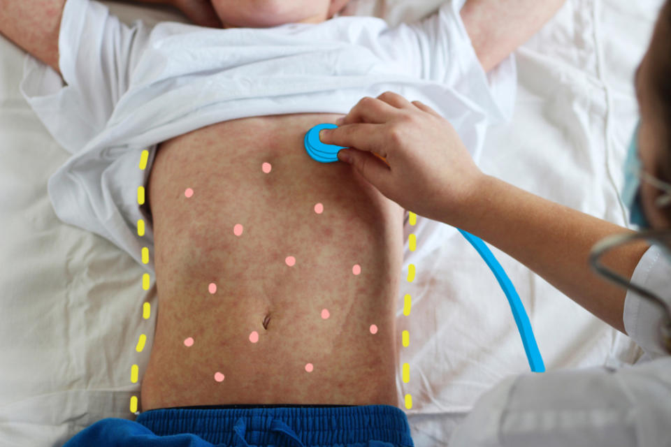 More than 100 cases of measles were confirmed in Rockland County since fall 2018. But the judge said that number isn't enough.